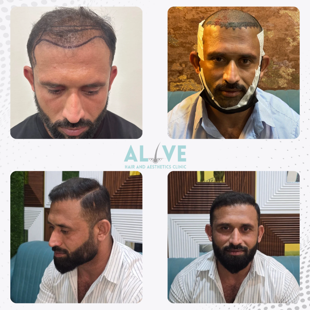 Male Hairline & Vertex Restoration