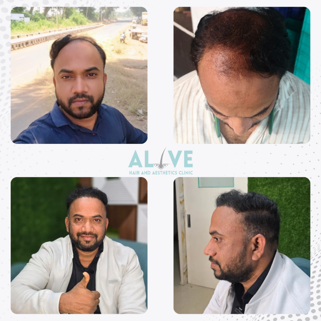 Receding Temporal Hairline Reconstruction